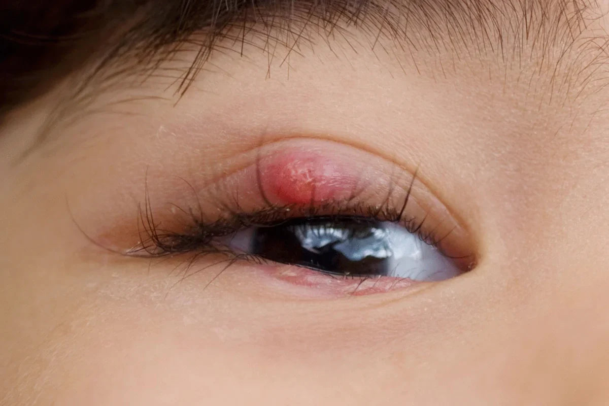 woman with stye